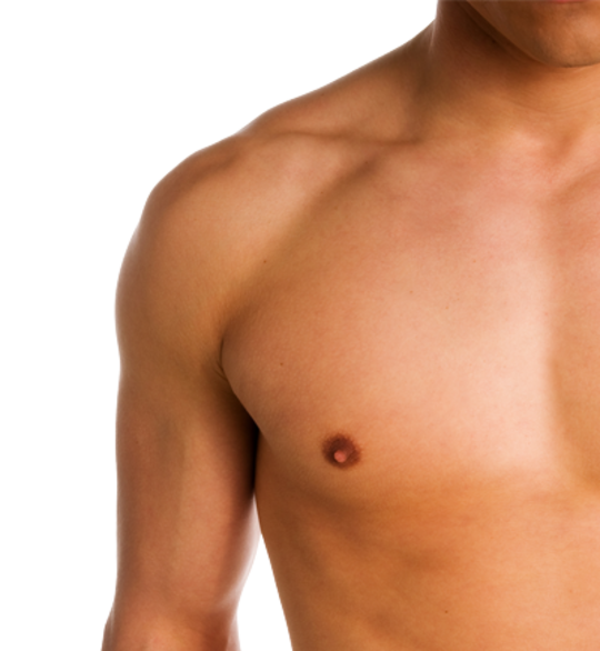 Breast reduction in the case of gynaecomastia