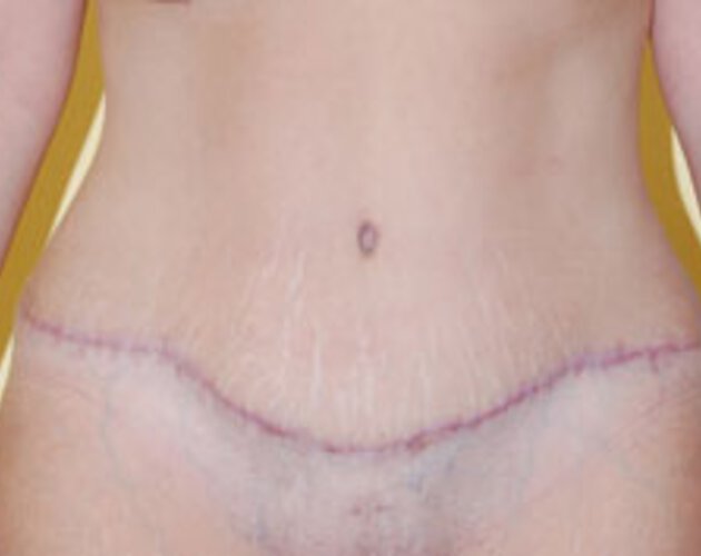 Abdominoplasty and tummy shaping Post - Dr. Schrank